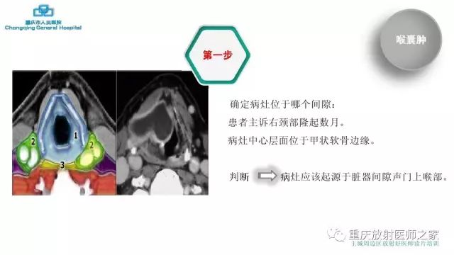 影像PPT - 【PPT】舌骨下颈部间隙划分及常见疾病的影像诊断-13