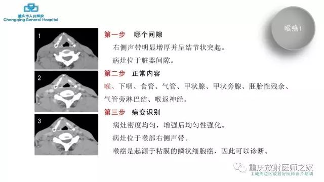 影像PPT - 【PPT】舌骨下颈部间隙划分及常见疾病的影像诊断-18