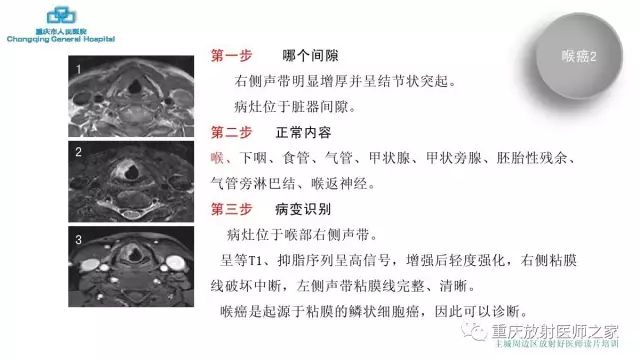 影像PPT - 【PPT】舌骨下颈部间隙划分及常见疾病的影像诊断-19