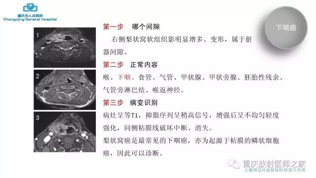 影像PPT - 【PPT】舌骨下颈部间隙划分及常见疾病的影像诊断-22
