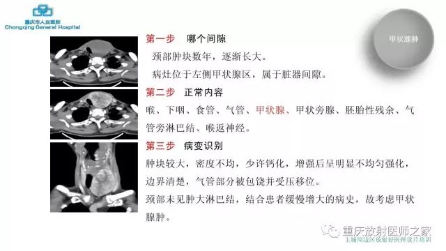 影像PPT - 【PPT】舌骨下颈部间隙划分及常见疾病的影像诊断-25