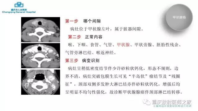 影像PPT - 【PPT】舌骨下颈部间隙划分及常见疾病的影像诊断-28