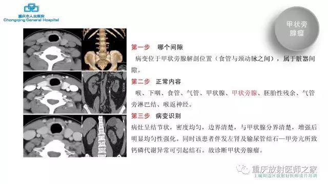 影像PPT - 【PPT】舌骨下颈部间隙划分及常见疾病的影像诊断-31