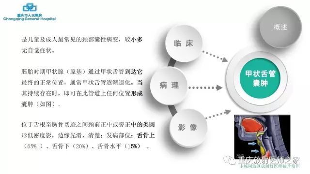 影像PPT - 【PPT】舌骨下颈部间隙划分及常见疾病的影像诊断-33