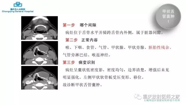 影像PPT - 【PPT】舌骨下颈部间隙划分及常见疾病的影像诊断-34