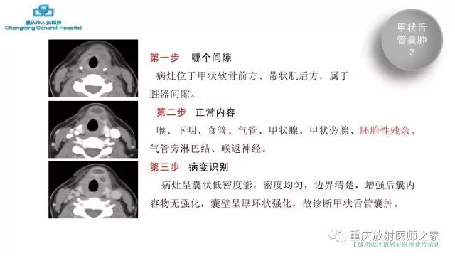 影像PPT - 【PPT】舌骨下颈部间隙划分及常见疾病的影像诊断-35