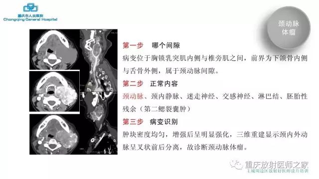 影像PPT - 【PPT】舌骨下颈部间隙划分及常见疾病的影像诊断-40