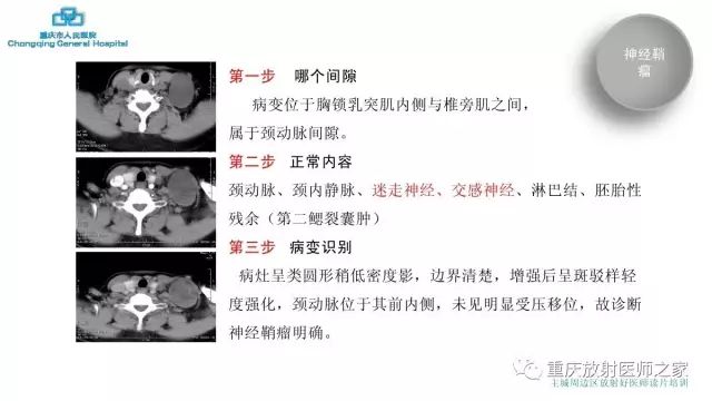 影像PPT - 【PPT】舌骨下颈部间隙划分及常见疾病的影像诊断-43