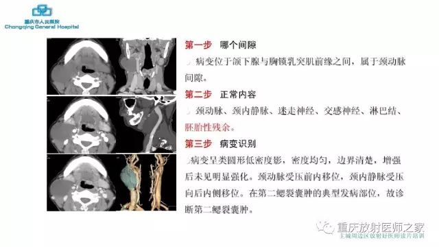 影像PPT - 【PPT】舌骨下颈部间隙划分及常见疾病的影像诊断-46