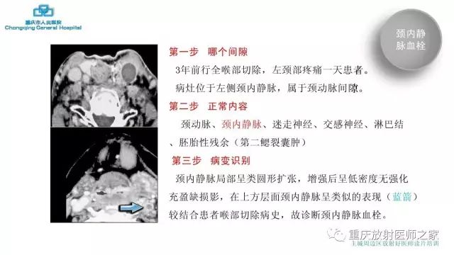 影像PPT - 【PPT】舌骨下颈部间隙划分及常见疾病的影像诊断-49