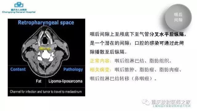 影像PPT - 【PPT】舌骨下颈部间隙划分及常见疾病的影像诊断-51