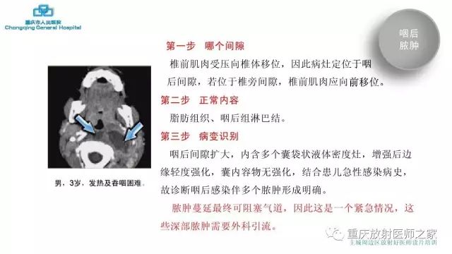 影像PPT - 【PPT】舌骨下颈部间隙划分及常见疾病的影像诊断-54
