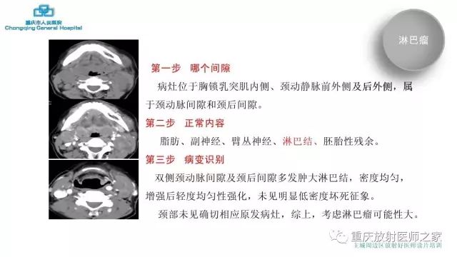 影像PPT - 【PPT】舌骨下颈部间隙划分及常见疾病的影像诊断-59