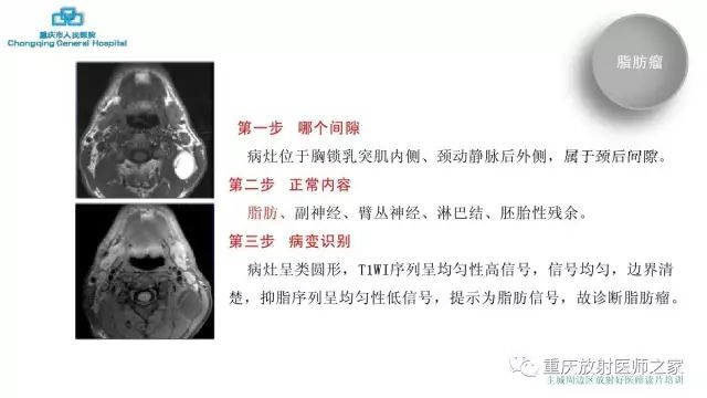 影像PPT - 【PPT】舌骨下颈部间隙划分及常见疾病的影像诊断-62