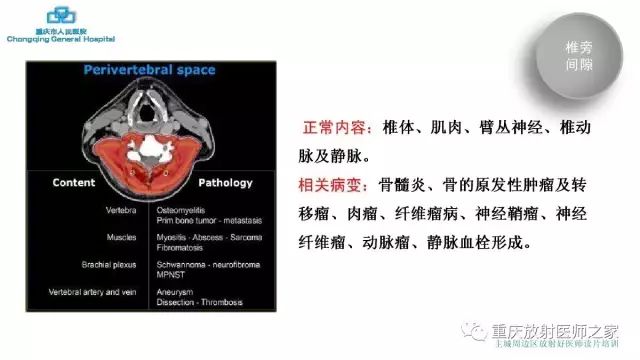影像PPT - 【PPT】舌骨下颈部间隙划分及常见疾病的影像诊断-67