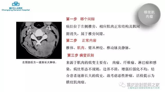 影像PPT - 【PPT】舌骨下颈部间隙划分及常见疾病的影像诊断-70