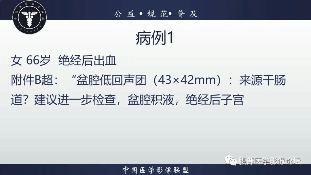影像PPT - 【病例】卵巢高级别浆液性癌1例CT影像-2 影像PPT - 【病例】卵巢高级别浆液性癌1例CT影像-2