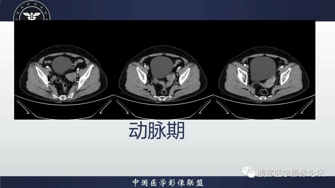 影像PPT - 【病例】卵巢高级别浆液性癌1例CT影像-5 影像PPT - 【病例】卵巢高级别浆液性癌1例CT影像-5