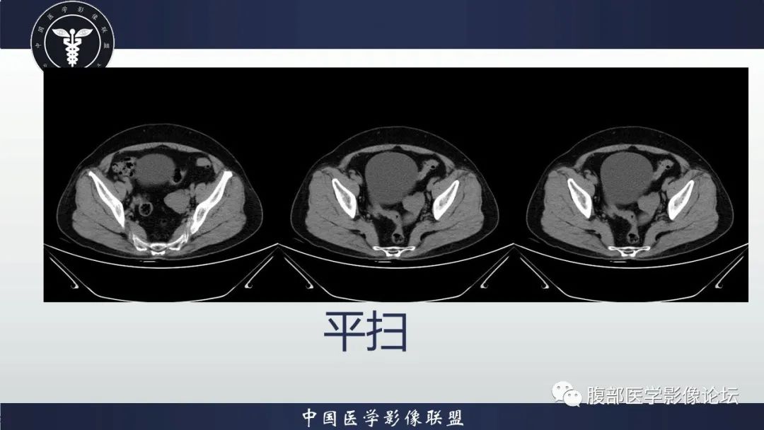 影像PPT - 【病例】卵巢高级别浆液性癌1例CT影像-4 影像PPT - 【病例】卵巢高级别浆液性癌1例CT影像-4