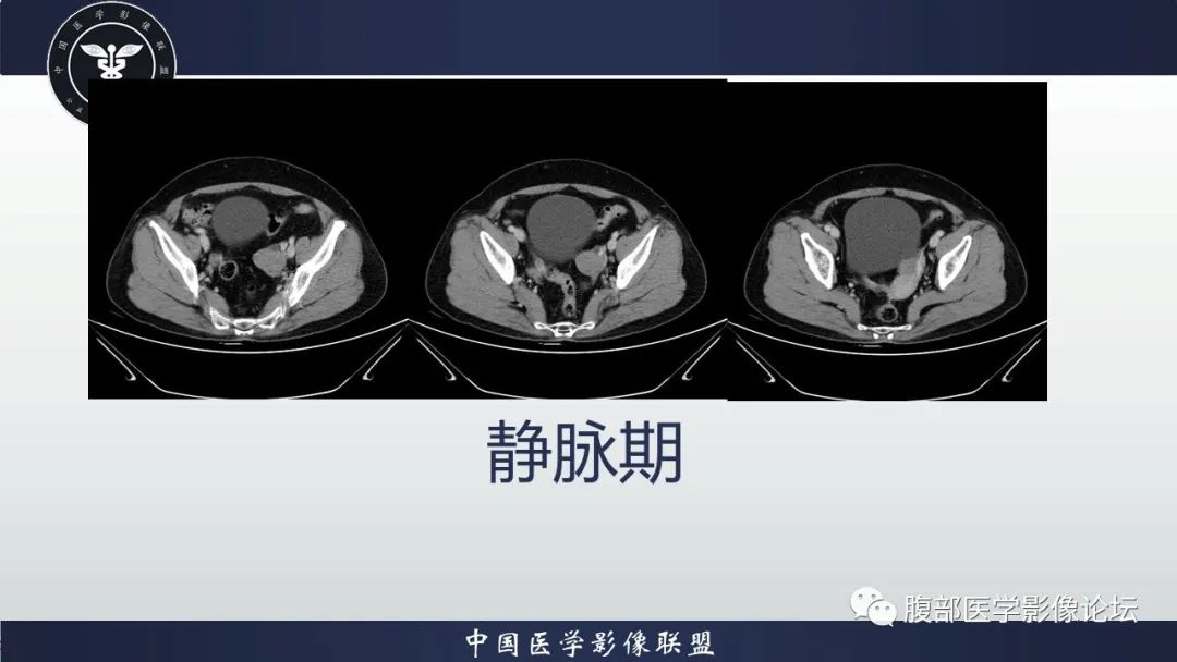影像PPT - 【病例】卵巢高级别浆液性癌1例CT影像-6 影像PPT - 【病例】卵巢高级别浆液性癌1例CT影像-6