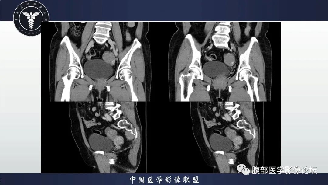 影像PPT - 【病例】卵巢高级别浆液性癌1例CT影像-7 影像PPT - 【病例】卵巢高级别浆液性癌1例CT影像-7