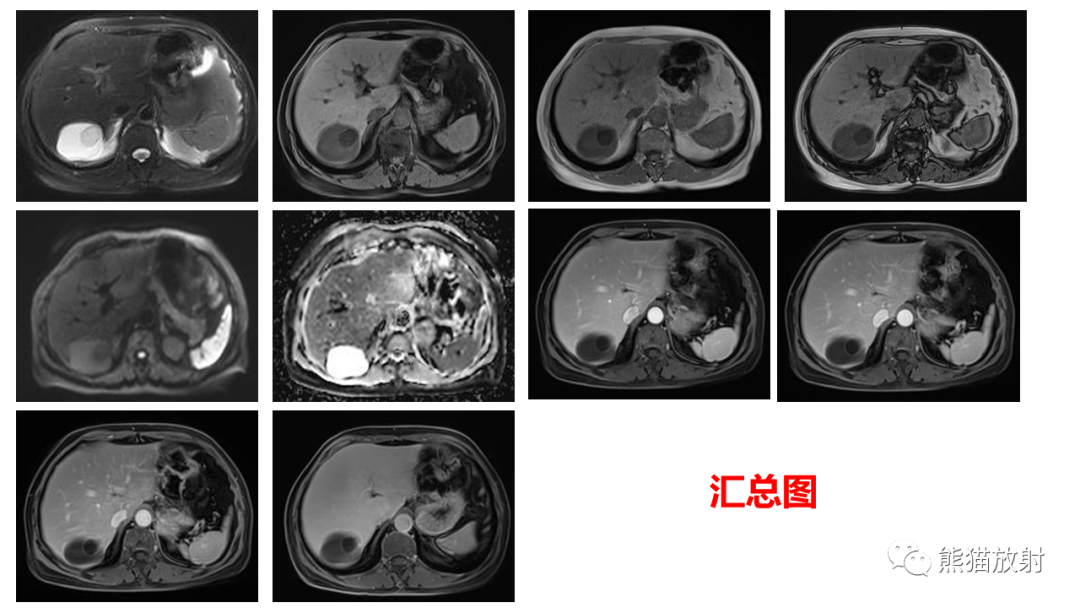 影像PPT - 【病例】肝脏胆管囊腺瘤2例MR影像-14