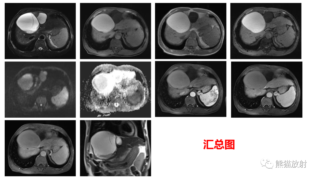 影像PPT - 【病例】肝脏胆管囊腺瘤2例MR影像-27