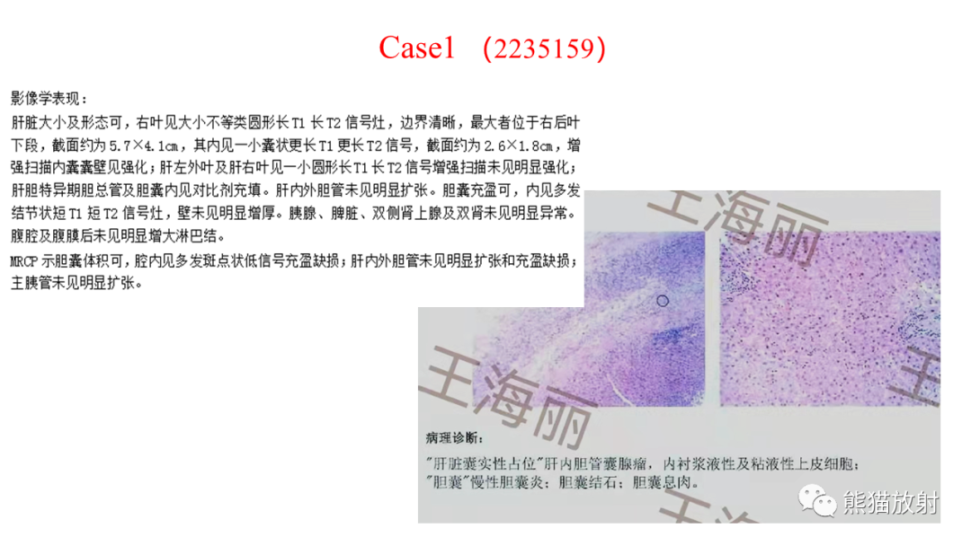 影像PPT - 【病例】肝脏胆管囊腺瘤2例MR影像-29