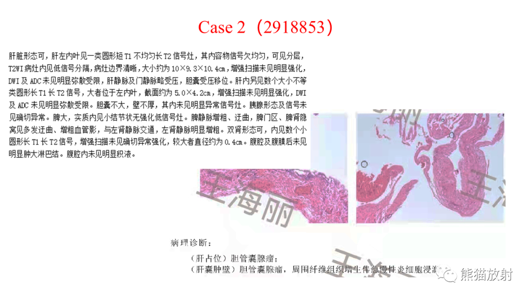 影像PPT - 【病例】肝脏胆管囊腺瘤2例MR影像-30