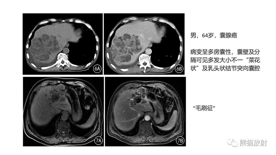 影像PPT - 【病例】肝脏胆管囊腺瘤2例MR影像-35