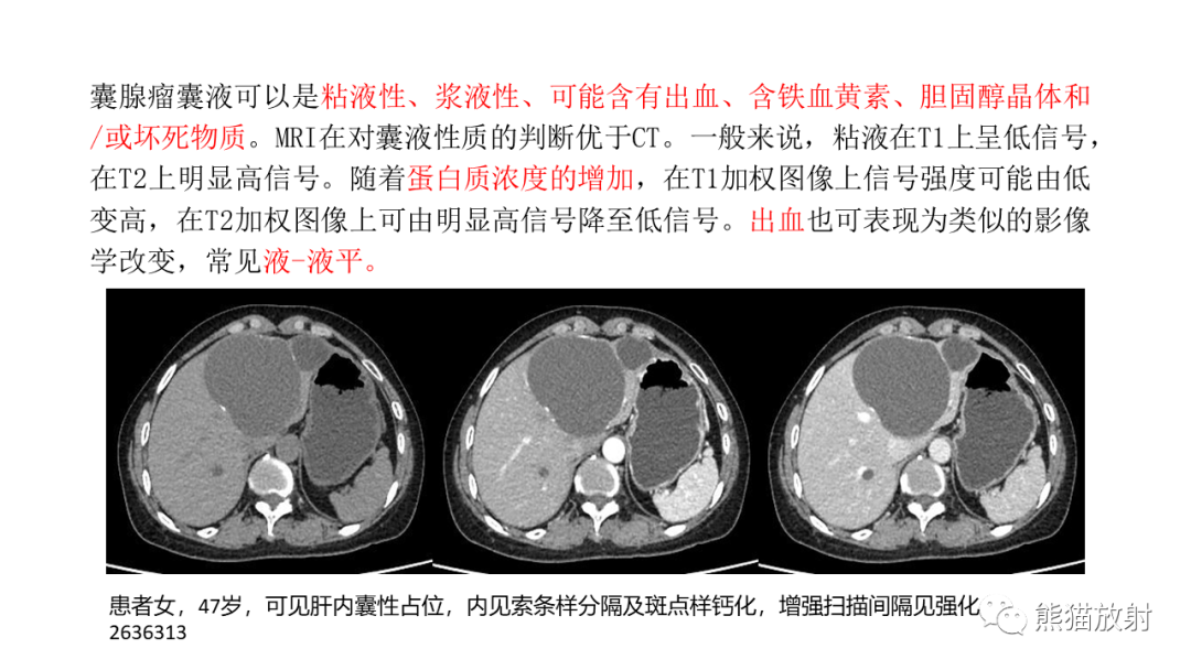 影像PPT - 【病例】肝脏胆管囊腺瘤2例MR影像-34