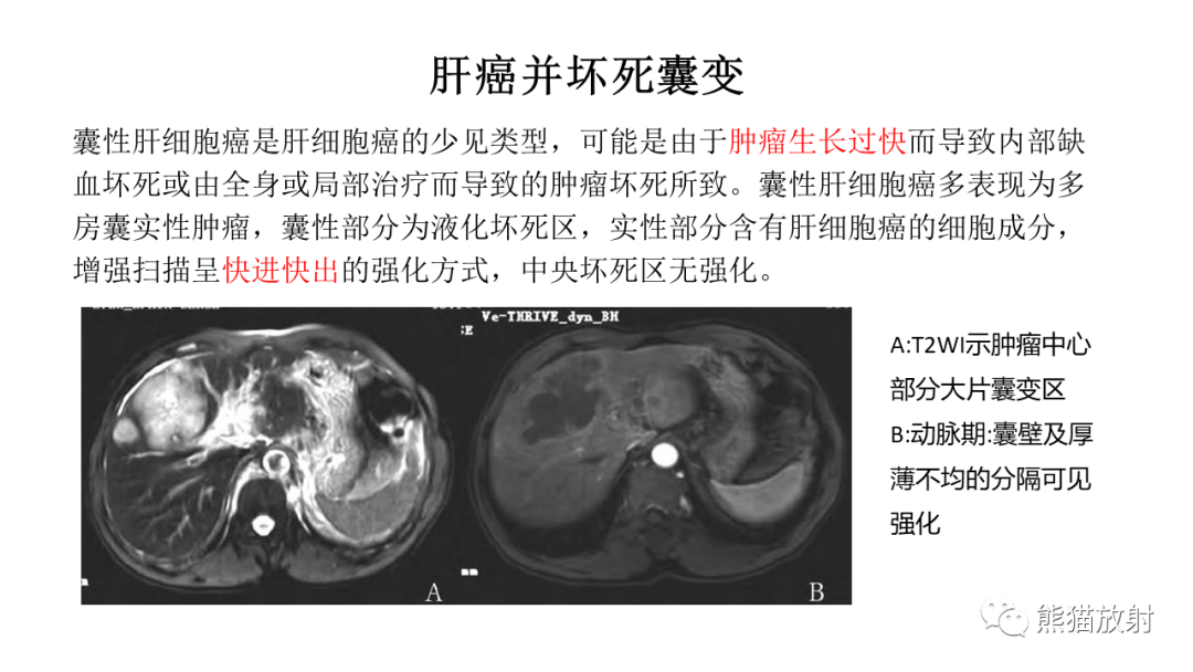 影像PPT - 【病例】肝脏胆管囊腺瘤2例MR影像-36