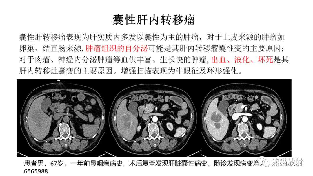 影像PPT - 【病例】肝脏胆管囊腺瘤2例MR影像-37