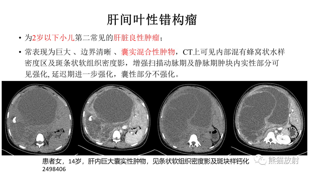 影像PPT - 【病例】肝脏胆管囊腺瘤2例MR影像-38