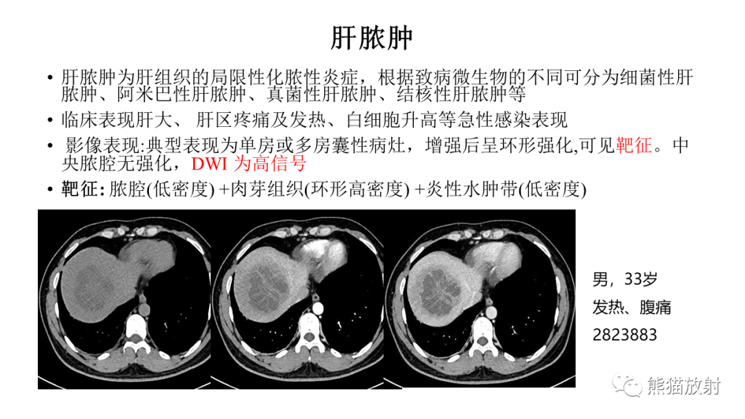 影像PPT - 【病例】肝脏胆管囊腺瘤2例MR影像-39