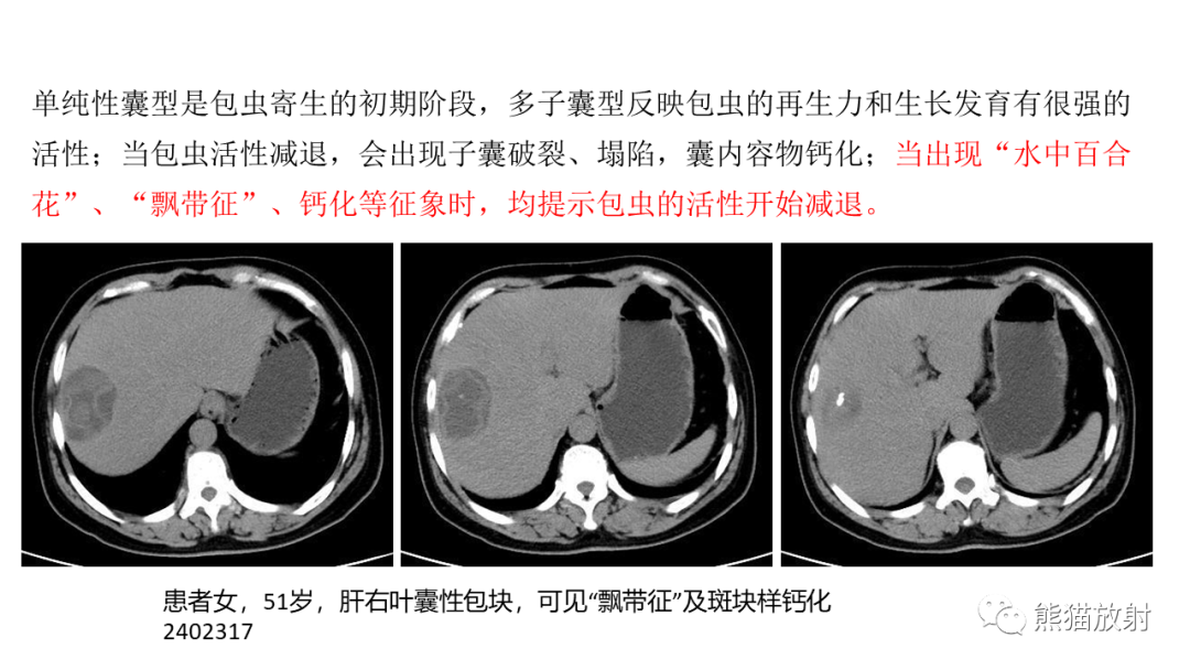 影像PPT - 【病例】肝脏胆管囊腺瘤2例MR影像-41