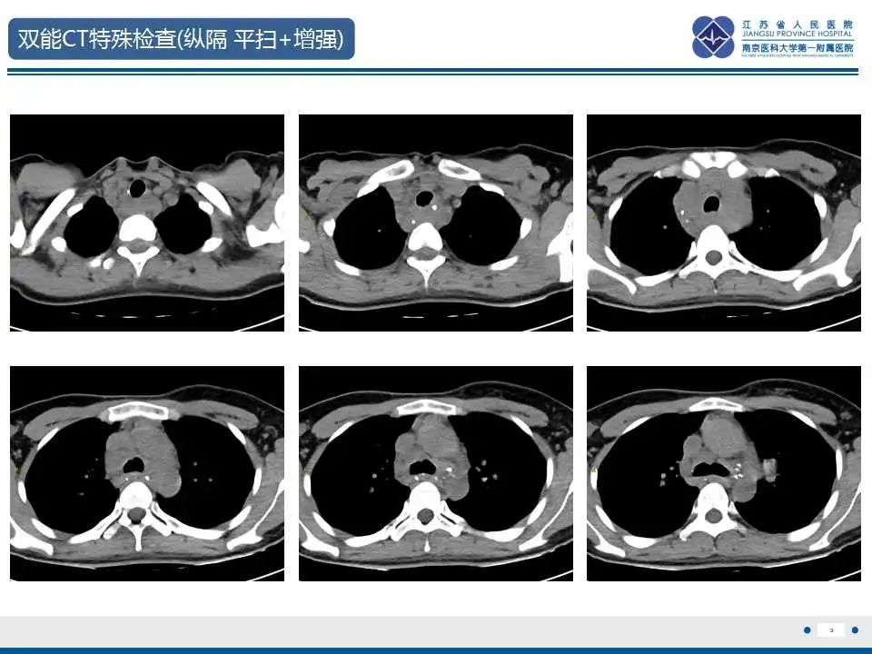 影像PPT - 【PPT】纵隔血管瘤-4