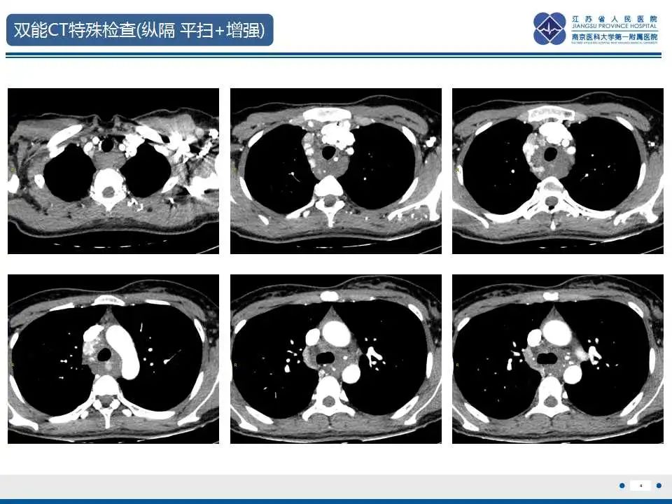 影像PPT - 【PPT】纵隔血管瘤-5