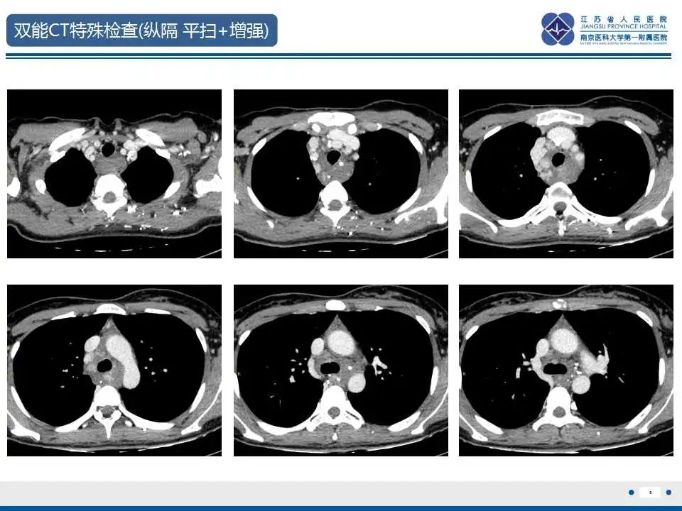 影像PPT - 【PPT】纵隔血管瘤-6