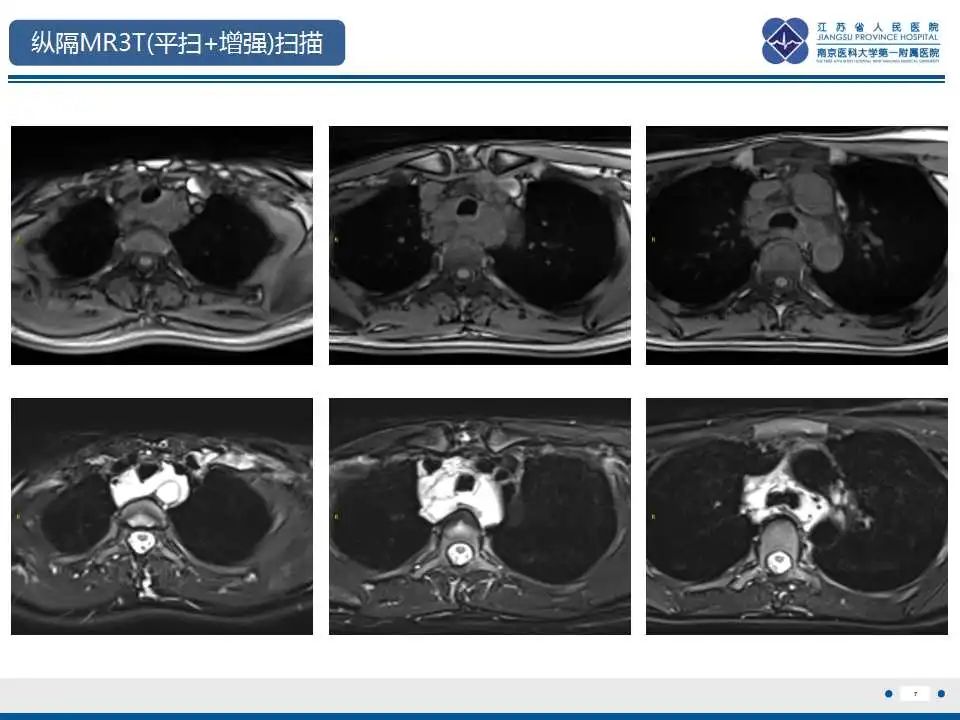 影像PPT - 【PPT】纵隔血管瘤-8