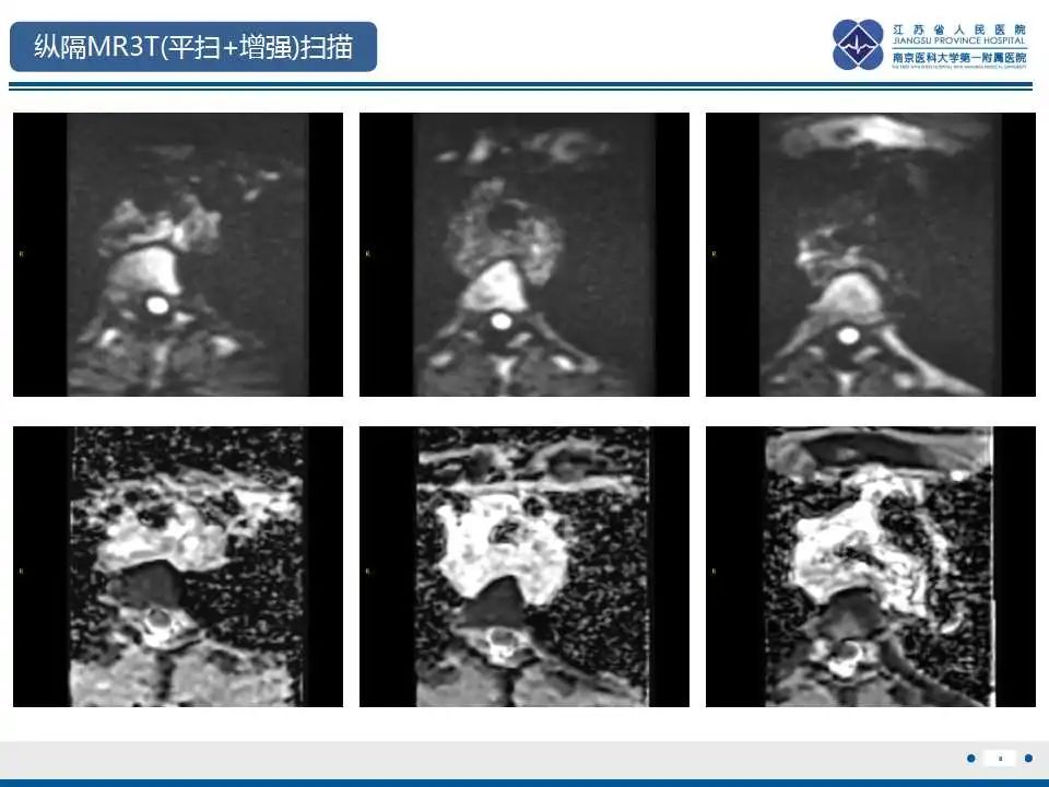 影像PPT - 【PPT】纵隔血管瘤-9