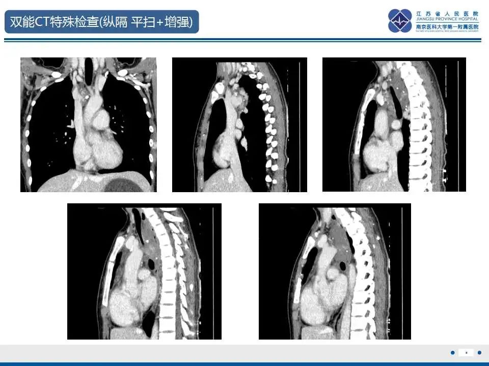 影像PPT - 【PPT】纵隔血管瘤-7