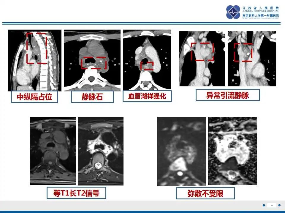 影像PPT - 【PPT】纵隔血管瘤-16