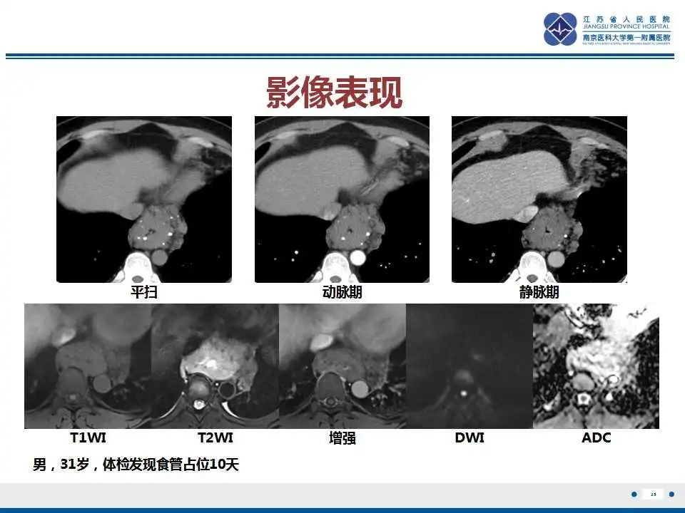 影像PPT - 【PPT】纵隔血管瘤-26