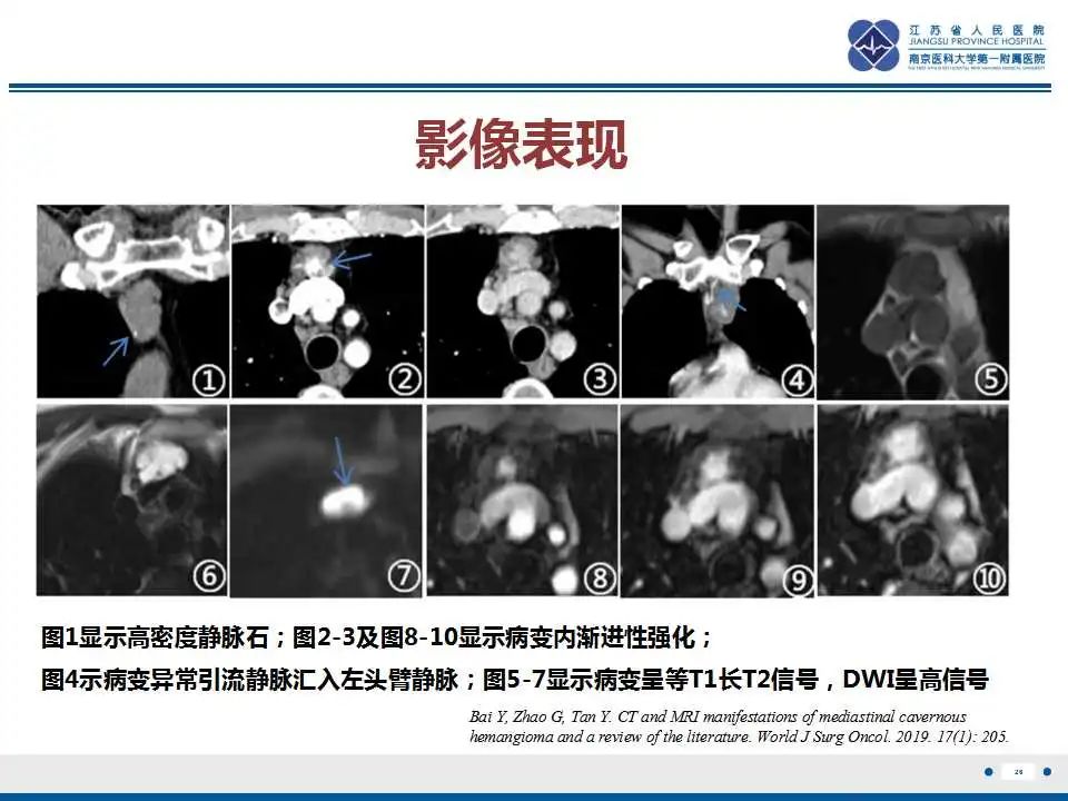 影像PPT - 【PPT】纵隔血管瘤-27