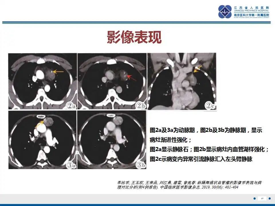 影像PPT - 【PPT】纵隔血管瘤-28