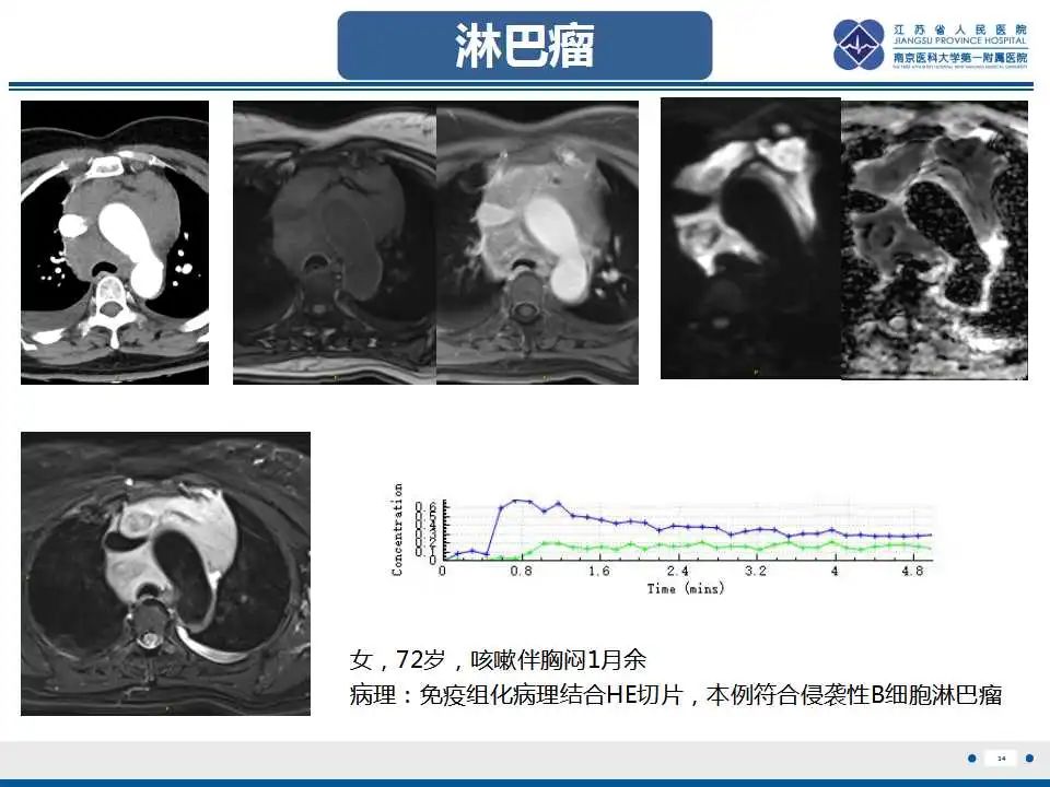 影像PPT - 【PPT】纵隔血管瘤-34