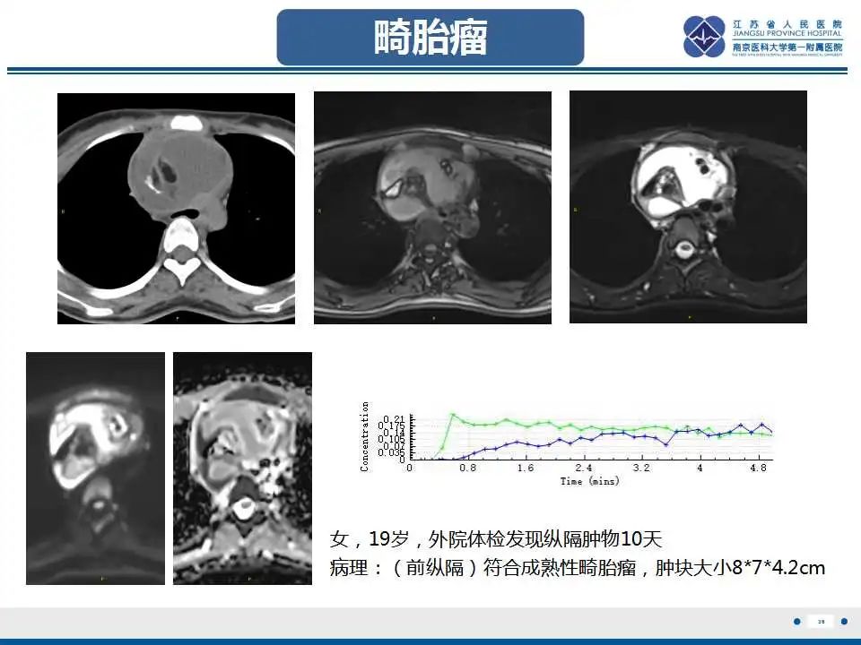 影像PPT - 【PPT】纵隔血管瘤-36