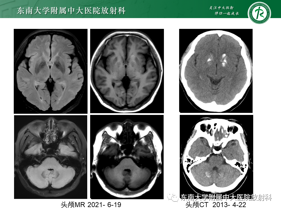 影像PPT - 【PPT】颅内多发钙化病例随诊-2