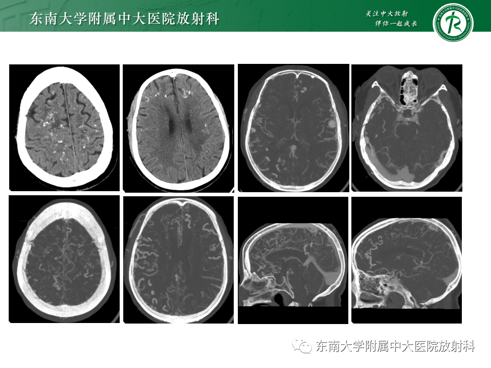 影像PPT - 【PPT】颅内多发钙化病例随诊-4